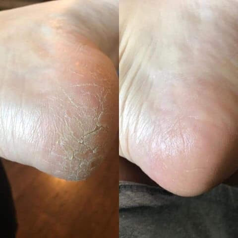 Sole Solution Foot Treatment 👣
