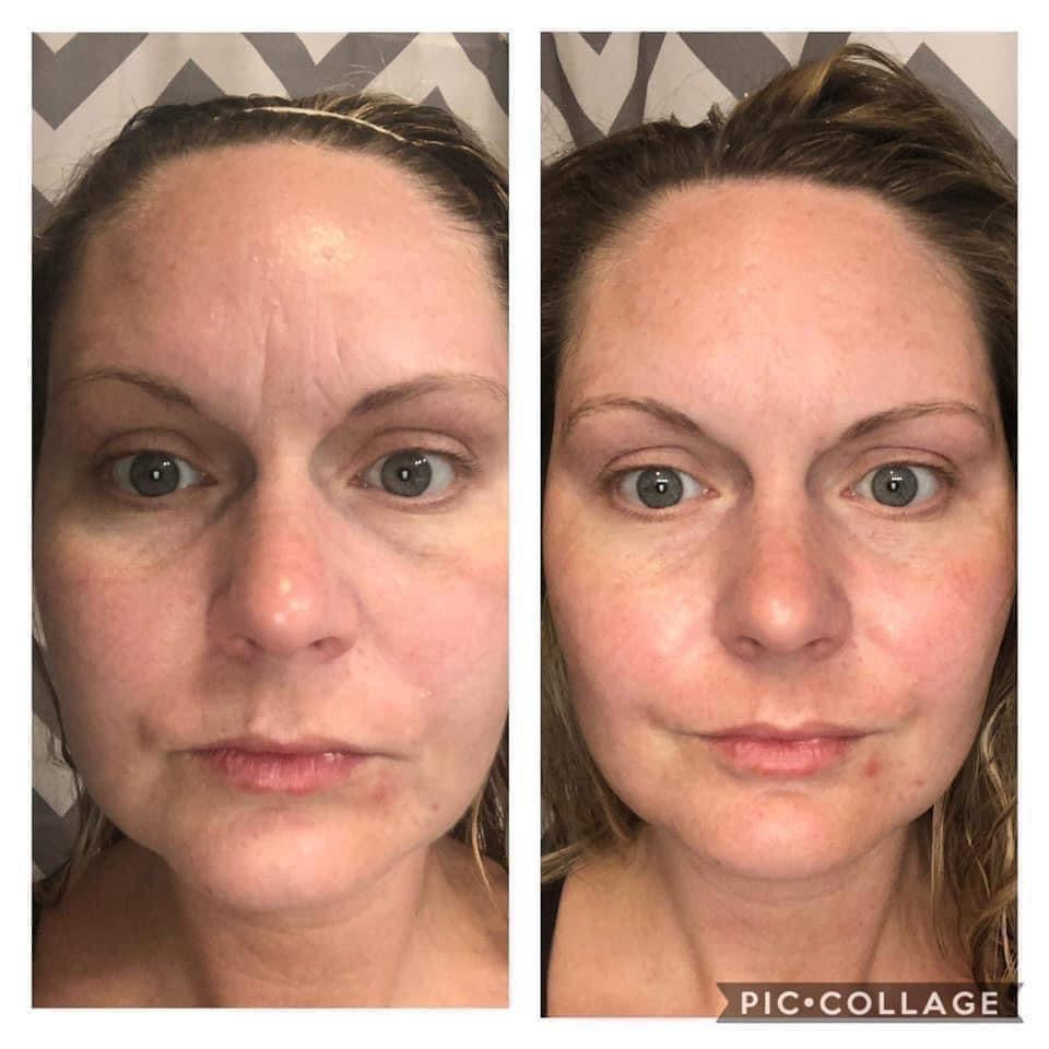 Face Lift with Activator Bundle