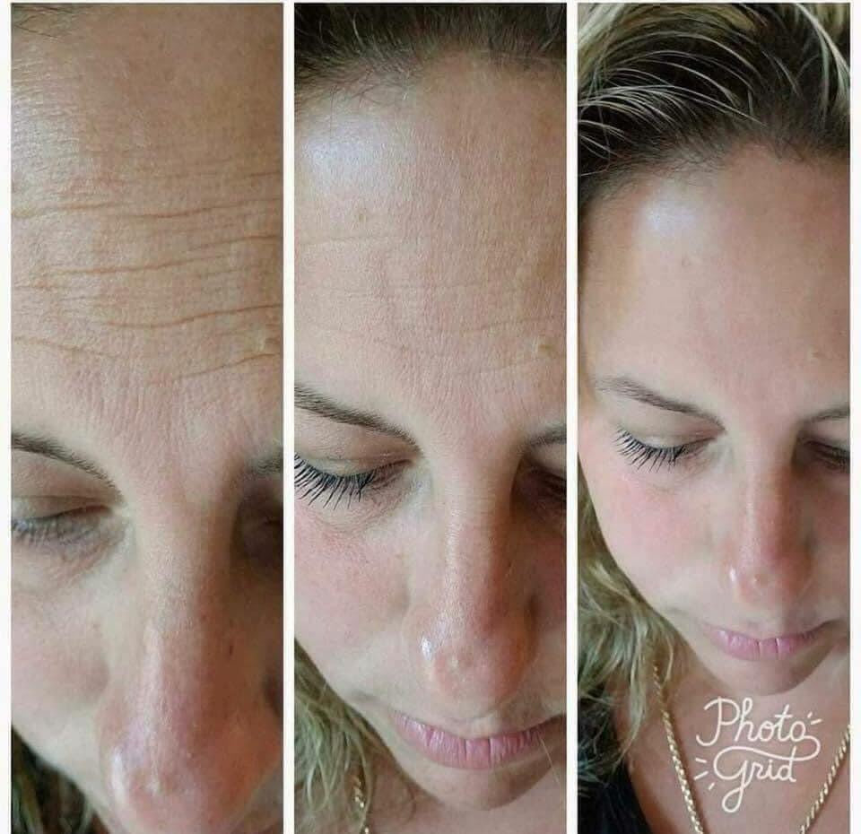 Face Lift with Activator